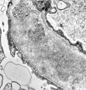  F,16y. | type III membranoproliferative glomerulonephritis